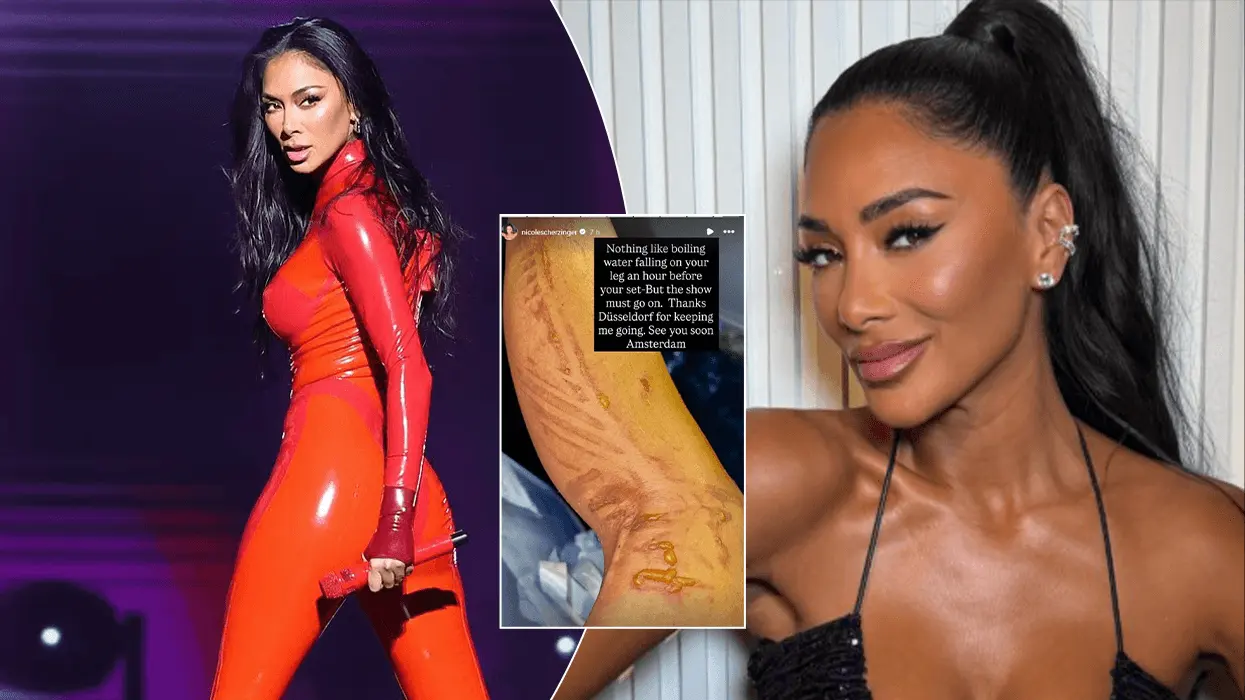 Nicole Scherzinger pëson djegie pak para koncertit, por nuk anulon performancën